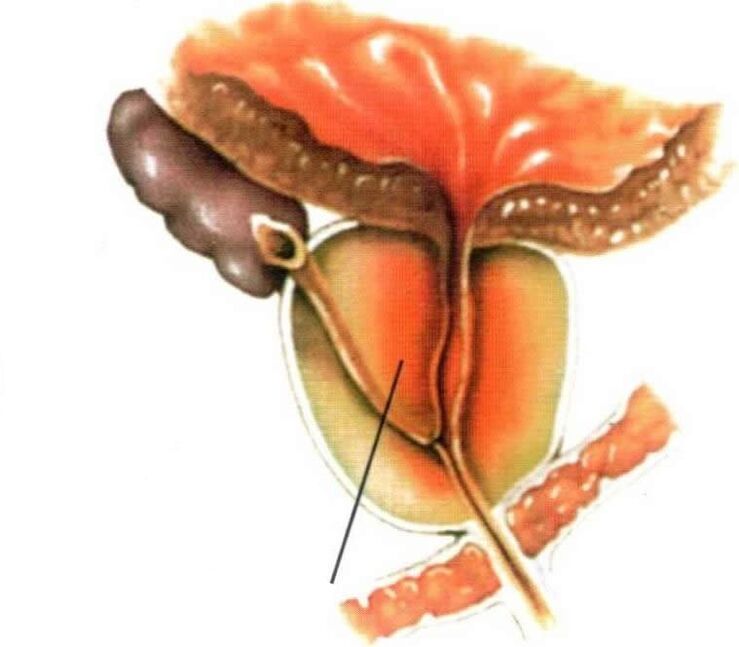 Inflamação do tecido da próstata na prostatite crônica