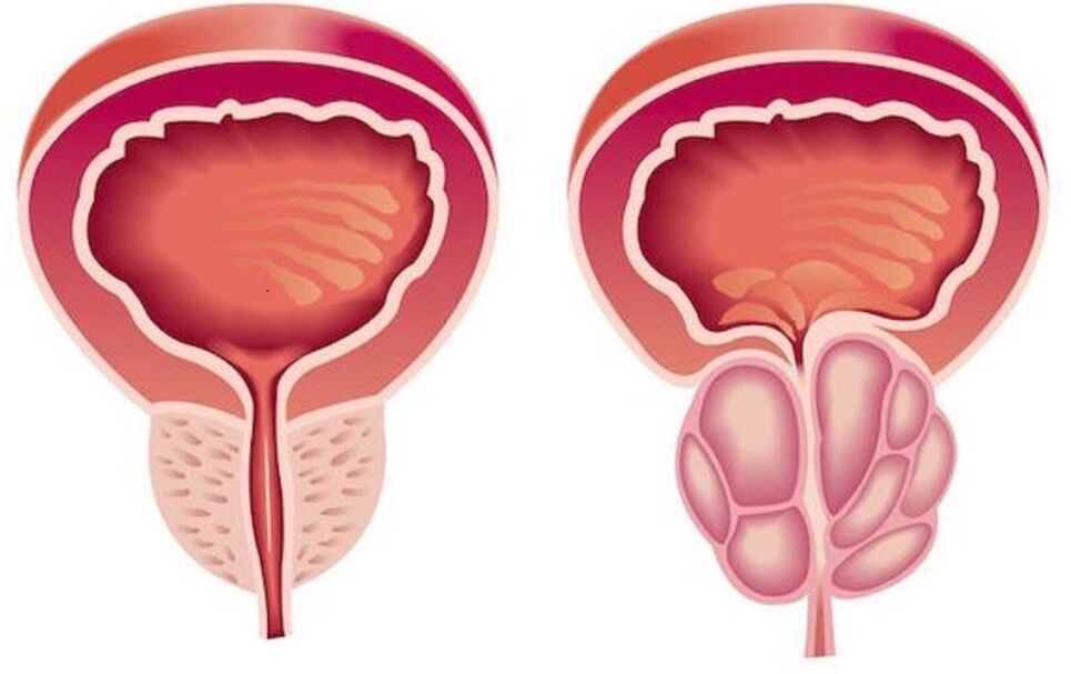 próstata saudável e inflamada com prostatite