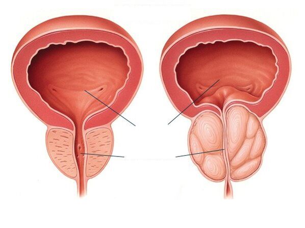 próstata normal e aumentada